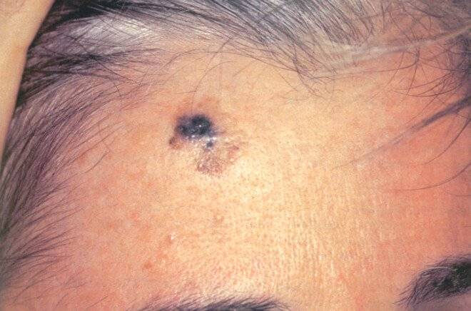  Dezmoplastični melanomi  
