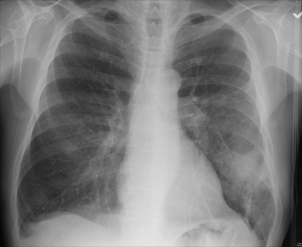 Microcellular lung cancer X-ray