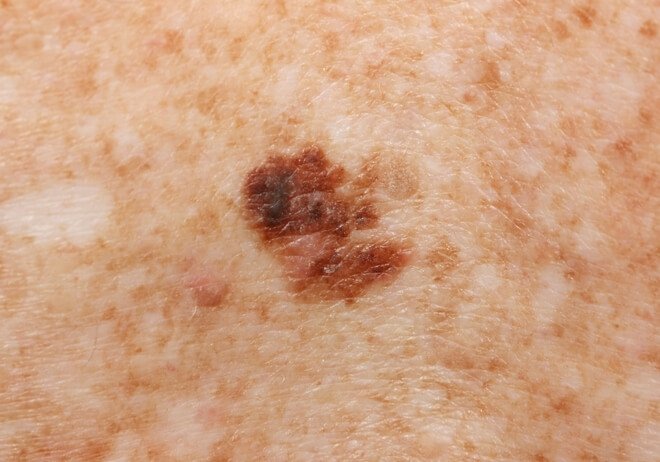  Površinski šireći melanom 