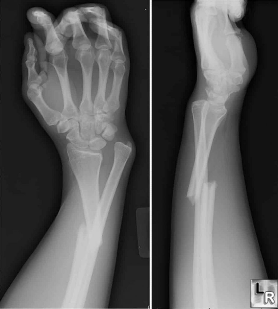 bone fracture X-ray