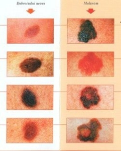 tumori kože podela