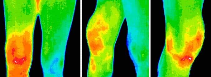 knee thermography