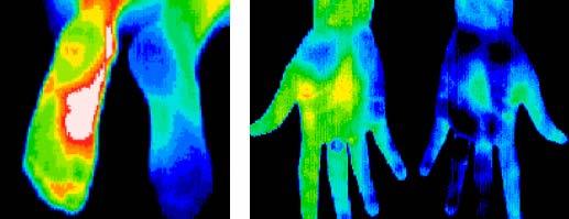 hand thermography